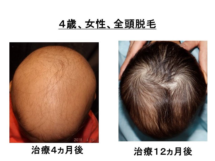 円形脱毛症　病院